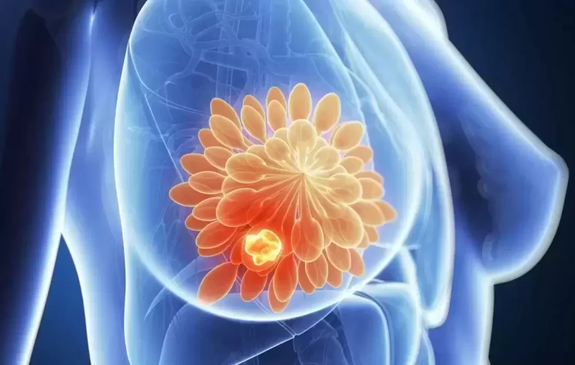 Ką apie krūties vėžį reikėtų žinoti kiekvienai moteriai