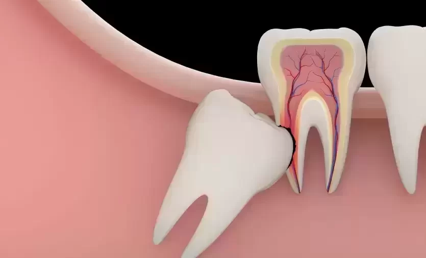 Protiniai dantys: šalinti ar palikti?