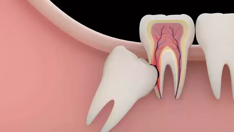 Protiniai dantys: šalinti ar palikti?