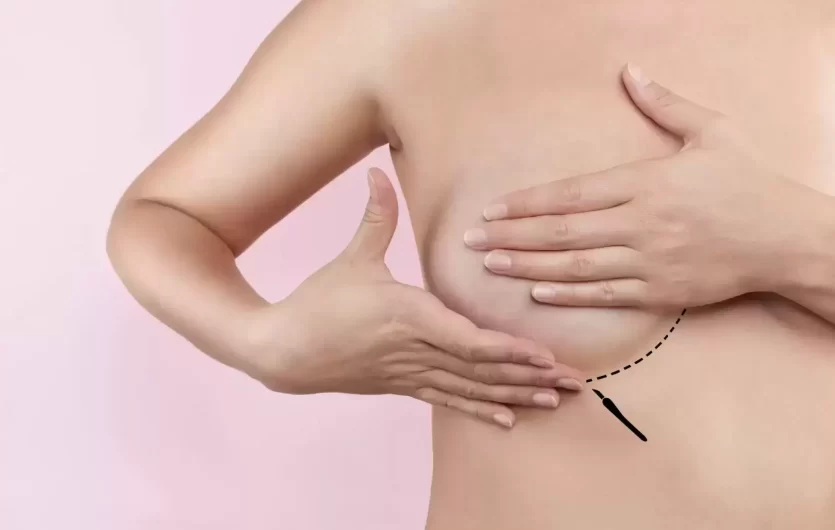 Krūtų implantų sukeliamos ligos: kaip prižiūrėti krūtų implantus ir kada juos keisti?