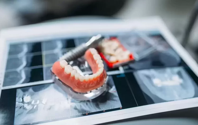 Odontologė paneigė tris didžiausius mitus apie dantų protezavimą